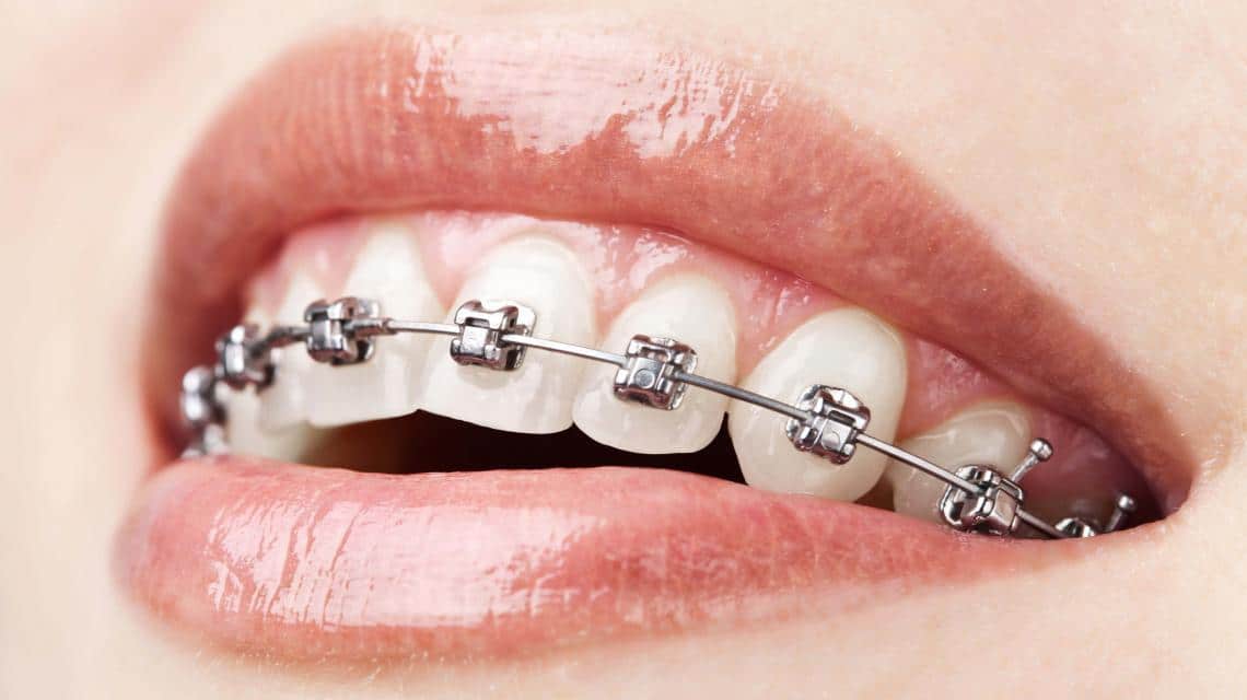 Traditional Metal or Clear Braces Braces for Adults