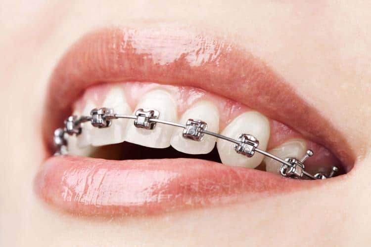 Traditional Metal or Clear Braces Braces for Adults