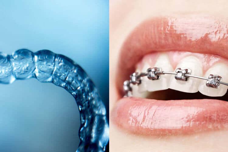 Invisalign or Braces