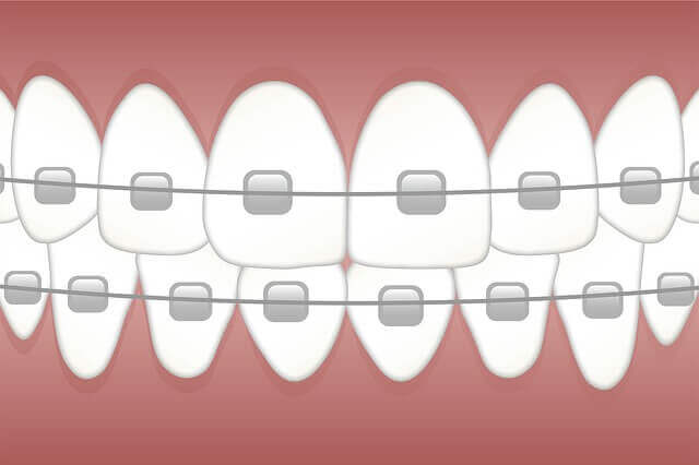 traditional braces