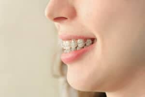 Does an Overbite Affect Your Jawline? - CaliSmile Orthodontics