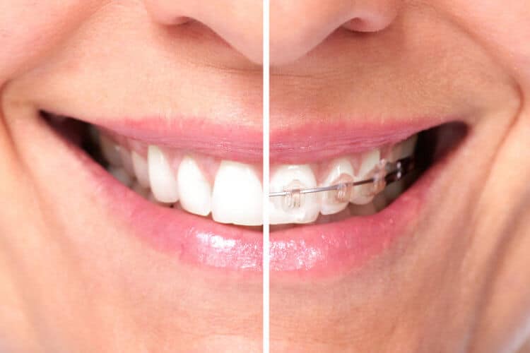 How Long Do You Have to Wear Braces? - CaliSmile Orthodontics