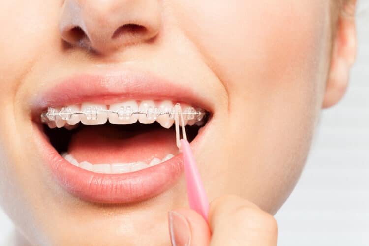 How to Take Care of Your Braces - CaliSmile Orthodontics