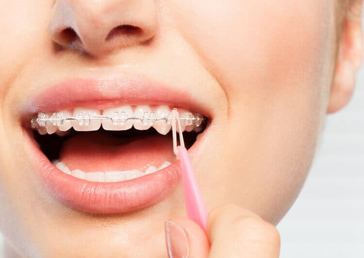 How to Take Care of Your Braces - CaliSmile Orthodontics