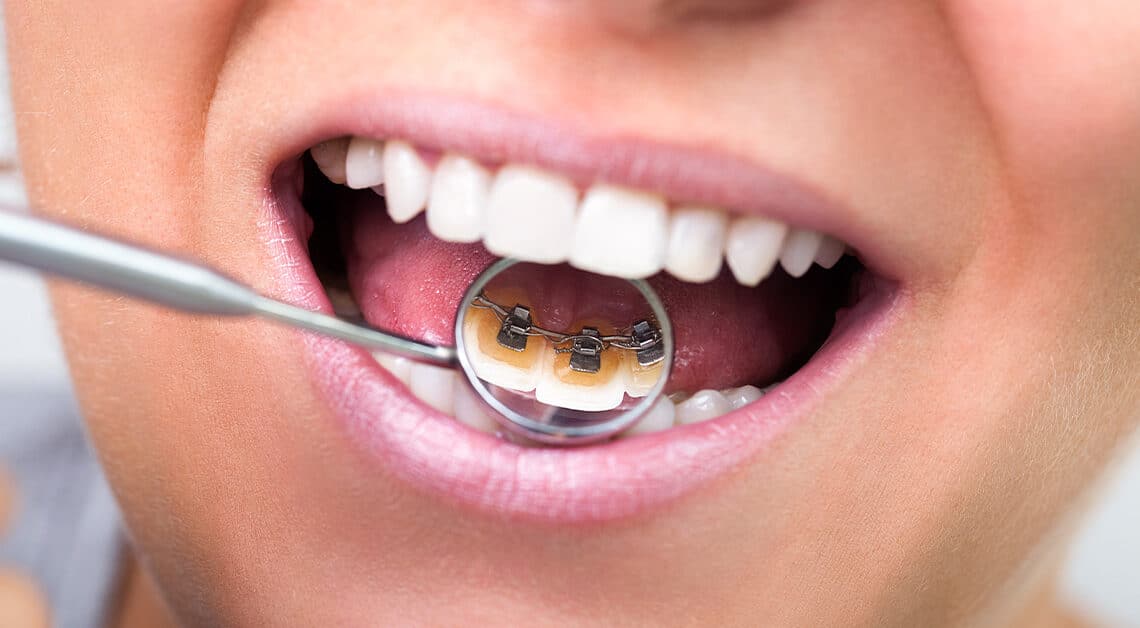 What are Lingual Braces? - CaliSmile Orthodontics