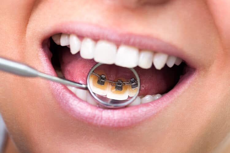 What are Lingual Braces? - CaliSmile Orthodontics