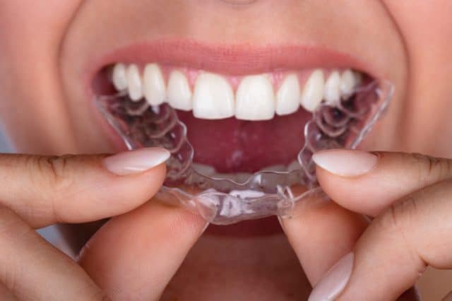 How Do I Clean My Retainers And Aligners? - CaliSmile Orthodontics