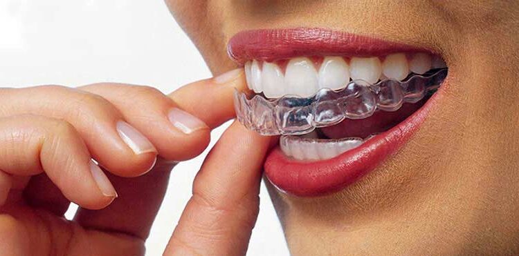 invisalign-candidate