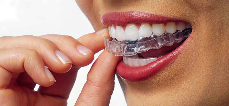 invisalign-candidate