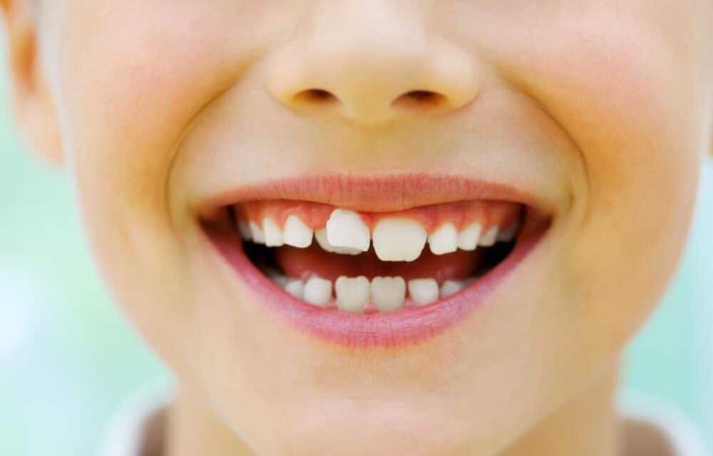 Does Thumb Sucking Cause Crooked Teeth? - CaliSmile Orthodontics