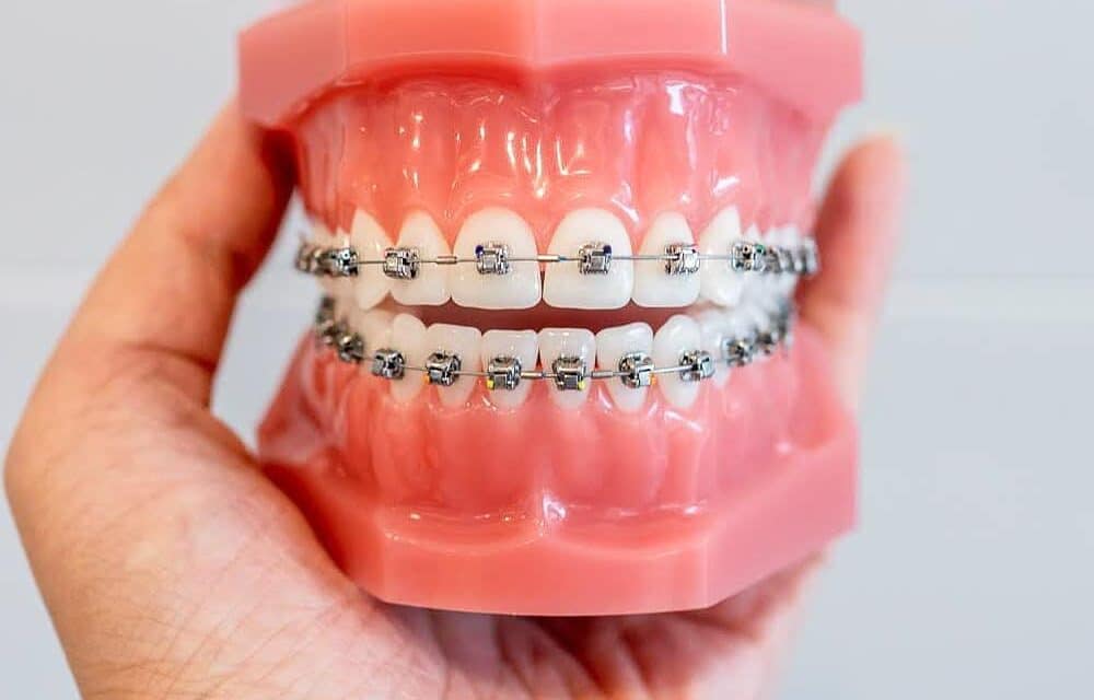 Braces for Adults in Los Angeles County