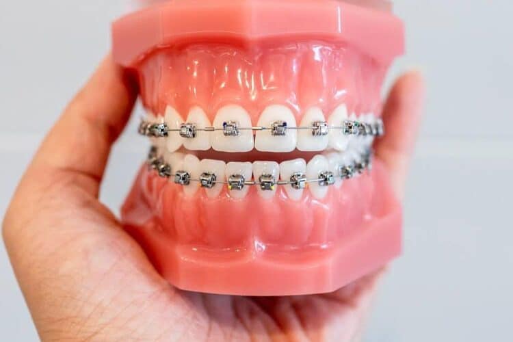 Braces for Adults in Los Angeles County