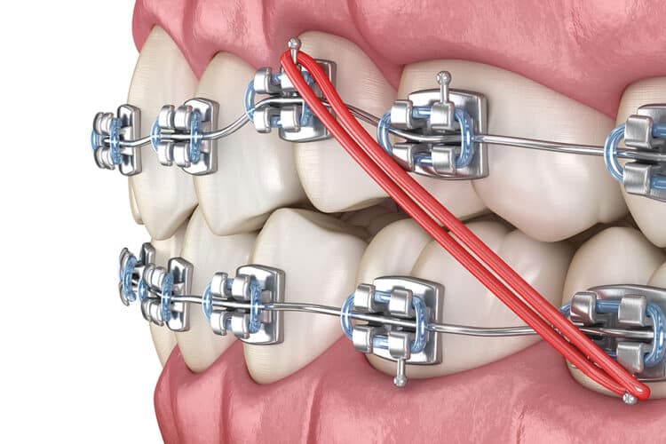 Answer To The Issue Of A Broken Bracket - CaliSmile Orthodontics