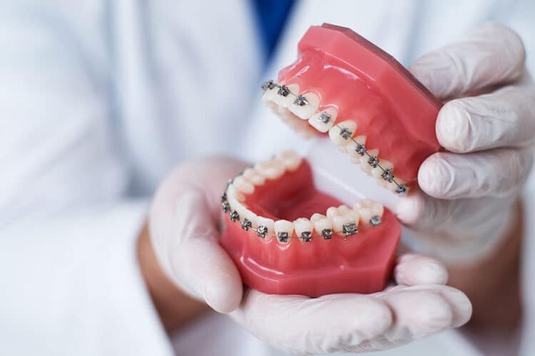 Seven Tips for Properly Caring for Your Metal Braces - CaliSmile Orthodontics