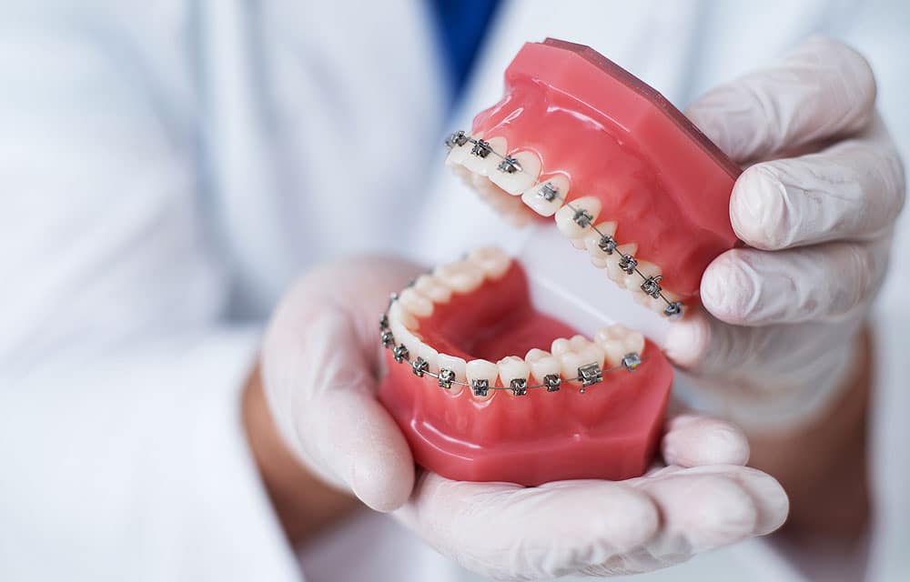 Seven Tips for Properly Caring for Your Metal Braces - CaliSmile Orthodontics