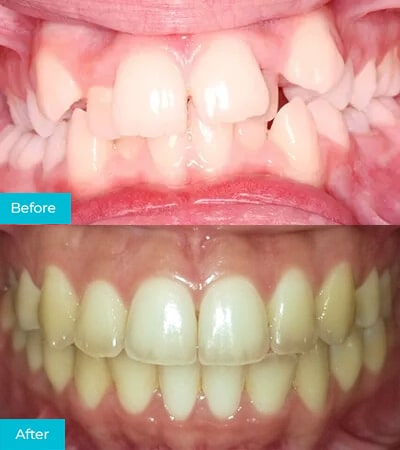 CaliSmile Orthodontics Before and After 4