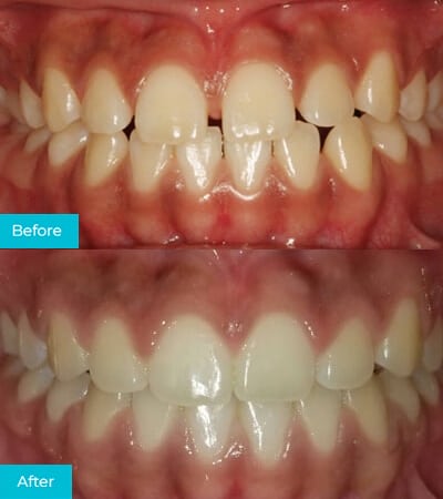 CaliSmile Orthodontics Before and After 3