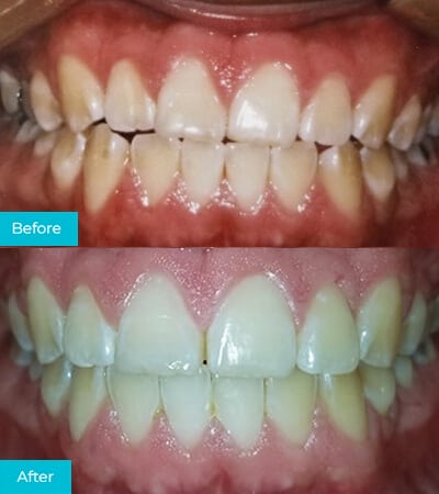 CaliSmile Orthodontics Before and After 5