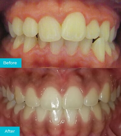 CaliSmile Orthodontics Before and After 2