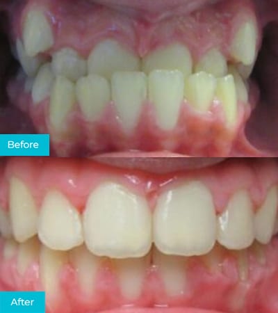 CaliSmile Orthodontics Before and After 1